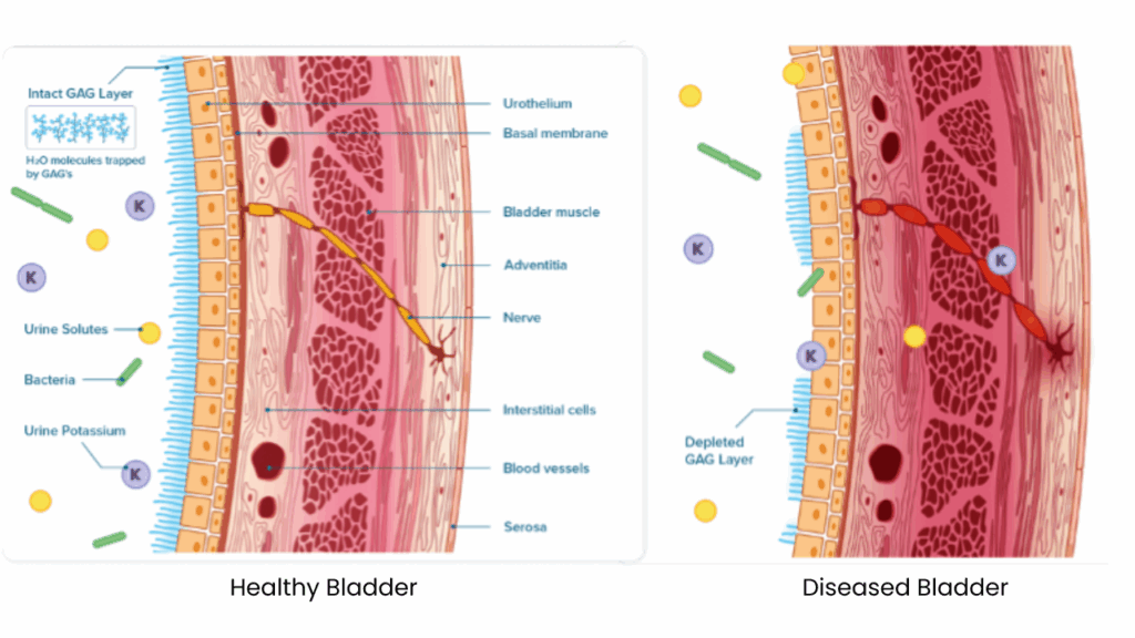 healthy vs diseased bladder wall